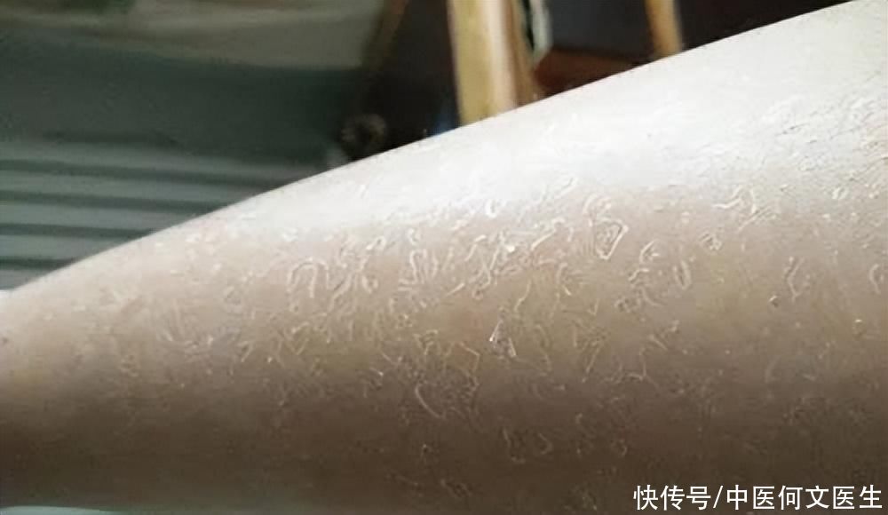 一脱秋裤就“皮屑满天飞”,这究竟是皮肤病,还是皮肤过于干燥? - 360娱乐,你开心就好